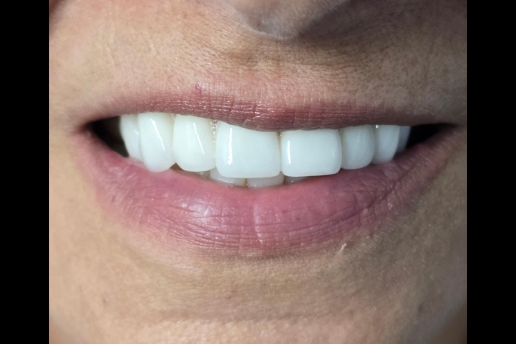 Minimally Invasive Cosmetic Dentistry