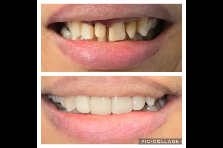 3 Veneers and 1 Crown to Transform the Smile