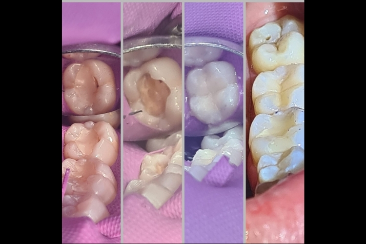 White Fillings at Church Lane Dental