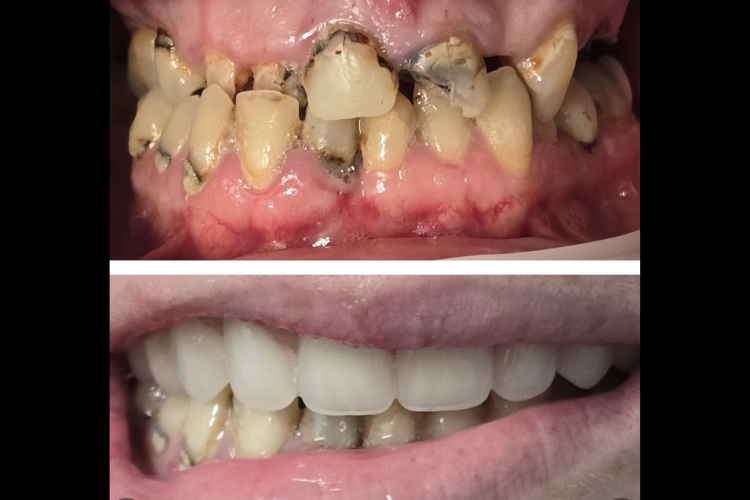 Same Day Teeth at Church Lane Dental