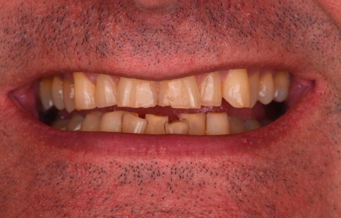 Porcelain Veneers and Clear Braces - Case 1 - before