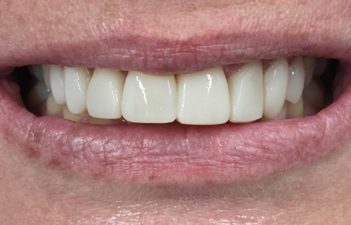 Cosmetic Bonding - Case 1 - After