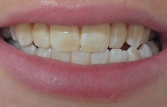 Cosmetic Bonding - Case 2 - Before