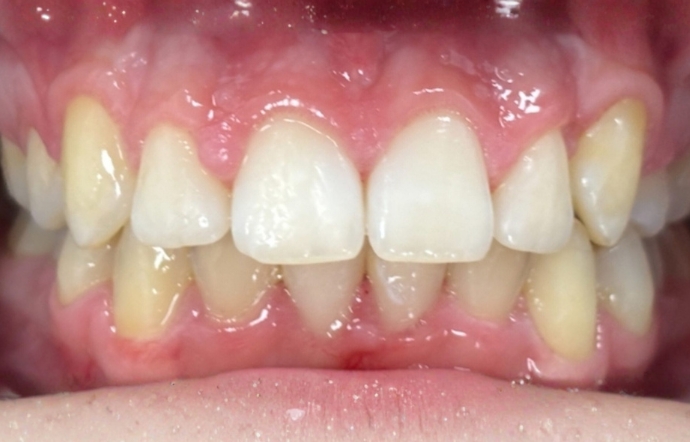 Invisalign - Case 1 - after