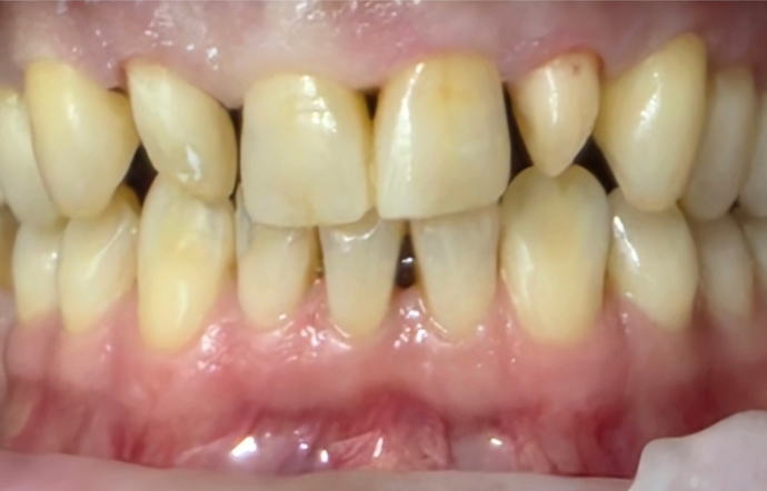 Porcelain Veneers and Clear Braces - Case 2 - before