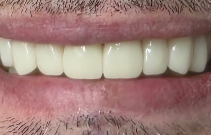 Porcelain Veneers and Clear Braces - Case 2 - after