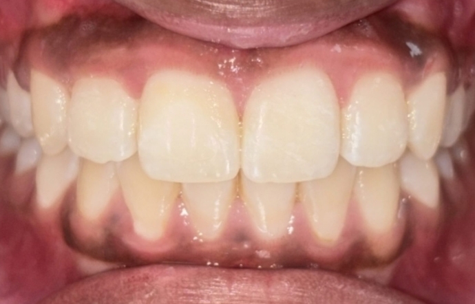 Porcelain Veneers and Clear Braces - Case 3 - after
