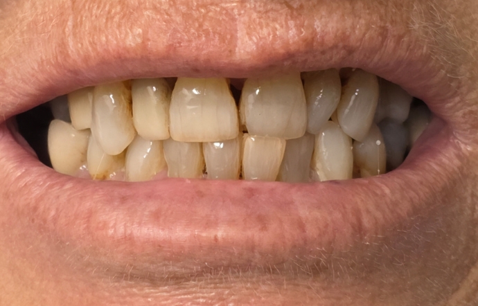 Smile Makeover - Case 1 - before