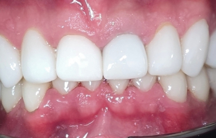 Smile Makeover - Case 2 - after