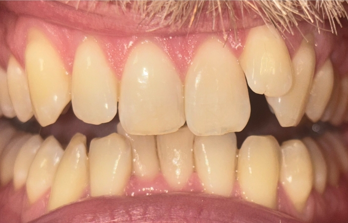 Invisalign - Case 2 - Before