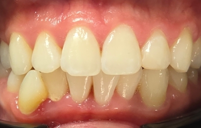 Porcelain Veneers - Case 1 - before