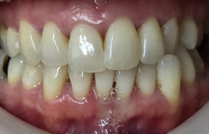 Porcelain Veneers and Clear Braces - Case 4 - before