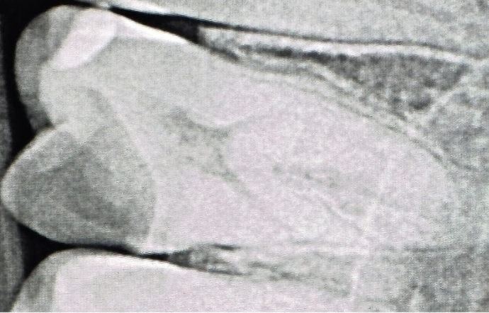 Root Canal Treatment - Case 1 - before