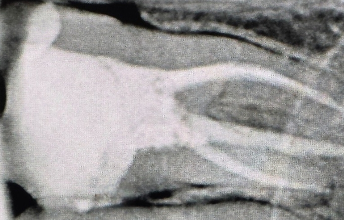 Root Canal Treatment - Case 1 - after