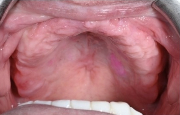 Dental implants - Case 1 - before