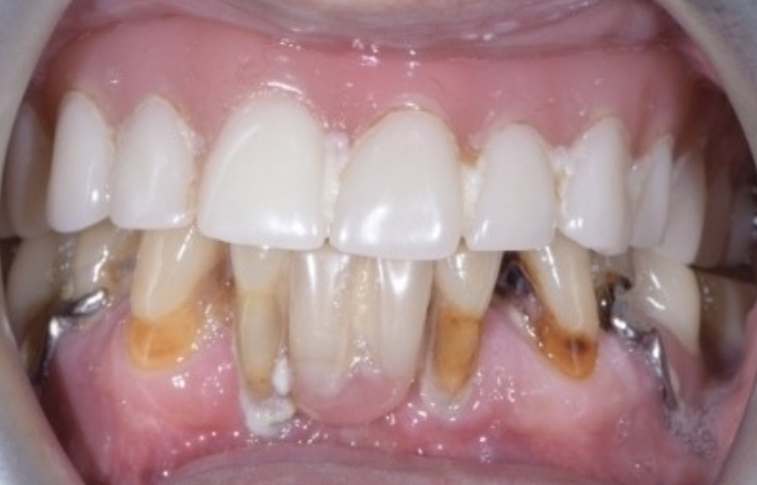 Dental implants - Case 2 - before