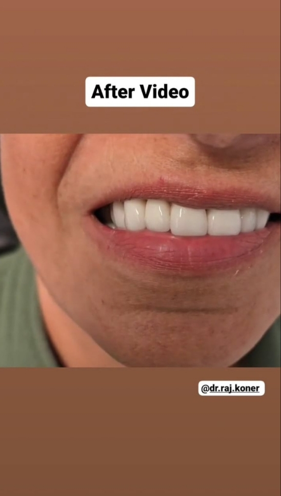 Cosmetic smile improvement