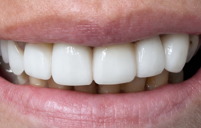 Dental Crowns - Case 1 after