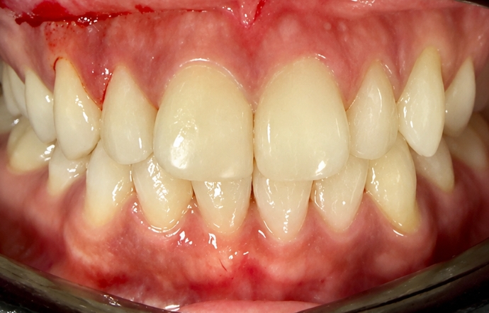 Cosmetic Bonding - Case 8 before
